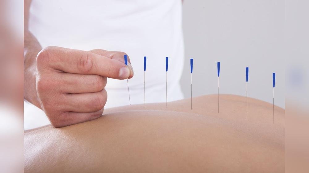 Acupuncture: Unlock Natural Healing and Pain Relief Today